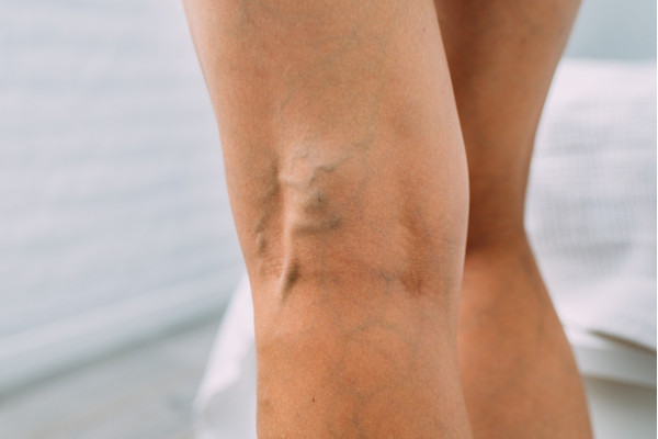 Leg vein treatment
