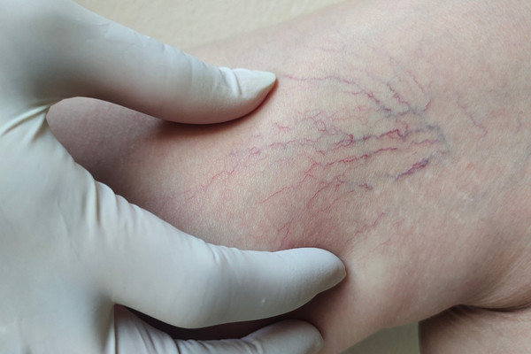 Leg vein treatment