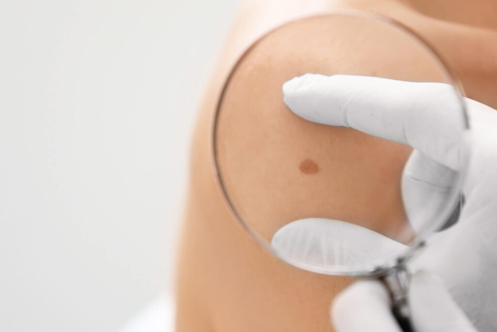 Close-up of a small brown mole on a shoulder being examined with a magnifying lens