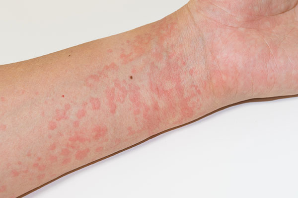 Hives