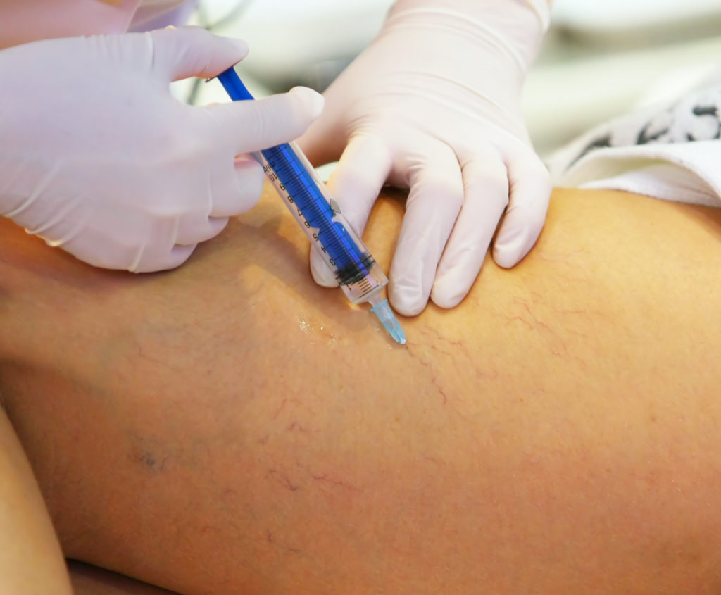 Leg Vein Treatments